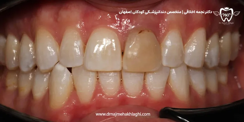 علت تغییر رنگ روکش دندان 