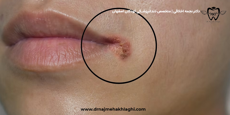 حساسیت به خمیردندان در کودکان