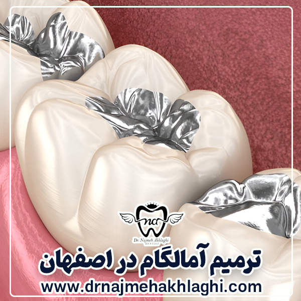 ترمیم آمالگام در اصفهان