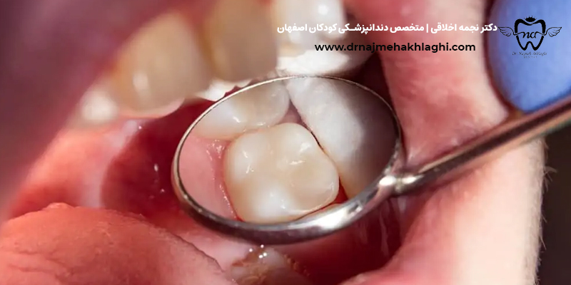 Temply-molars.jpgeth0