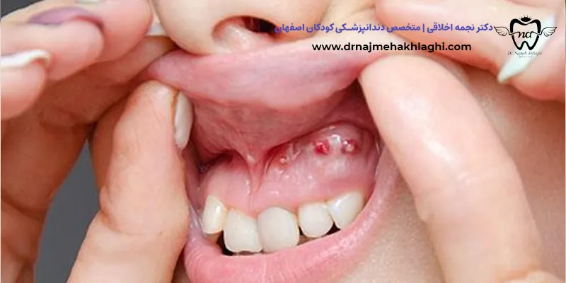علت بروز کیست و تومور در دهان 
