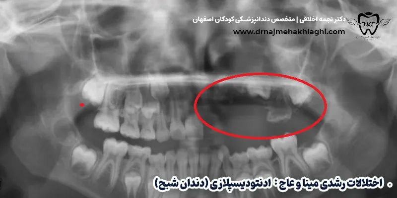 بیماری های مینای دندان