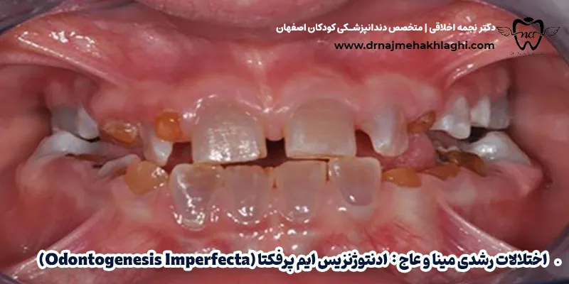 بیماری های مینای دندان