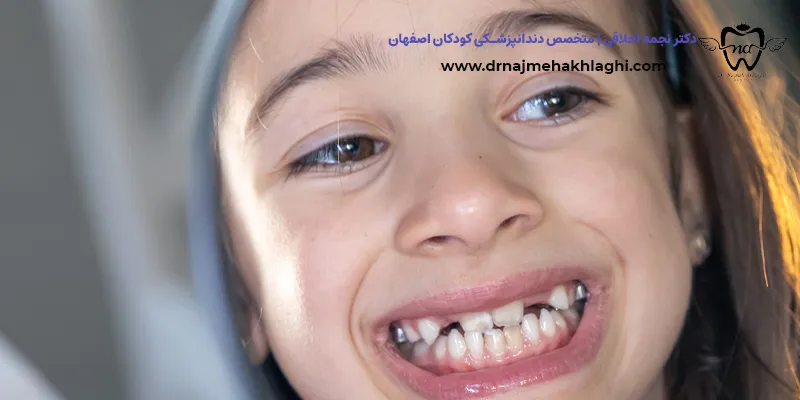 علت دیر درآمدن دندان دائمی کودک