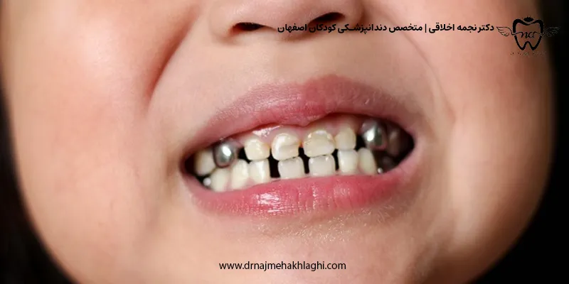 آیا همه دندان های شیری عصب کشی شده نیازمند روکش هستند؟