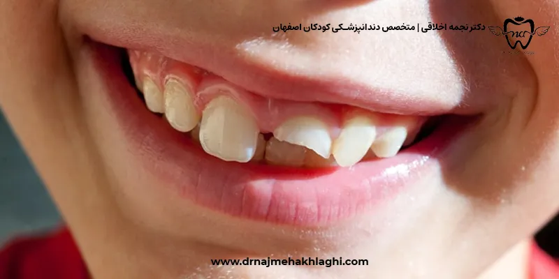 علت لب پر شدن دندان در کودکان