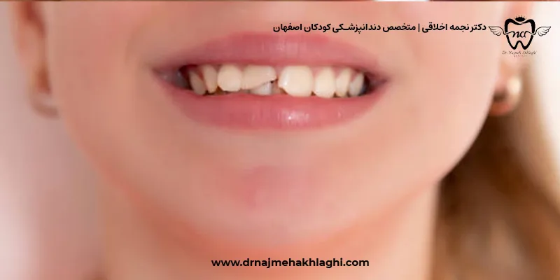 درمان لب پر شدن دندان شیری در کودکان