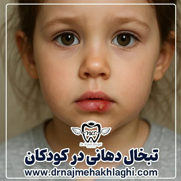 تبخال دهانی در کودکان:پیشگیری، تشخیص و درمان
