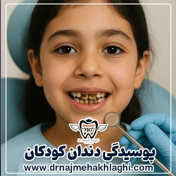 پیشگیری از پوسیدگی دندان دائمی کودکان