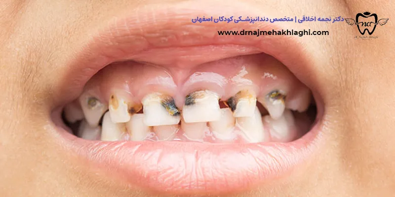 پوسیدگی دندان دائمی کودکان