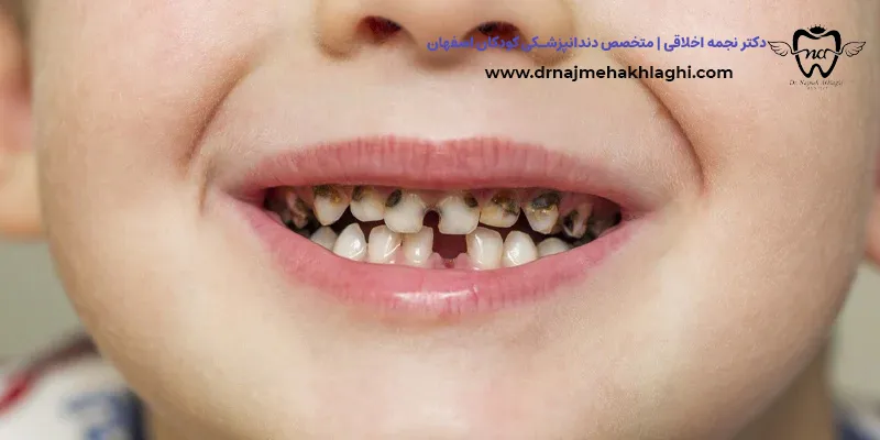 پوسیدگی دندان کودک