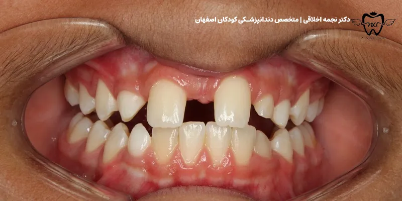 ایمپلنت دندان در کودکان مبتلا به فقدان مادرزادی (آژنزیس)