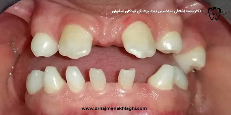 ایمپلنت دندان در کودکان مبتلا به فقدان مادرزادی (آژنزیس)