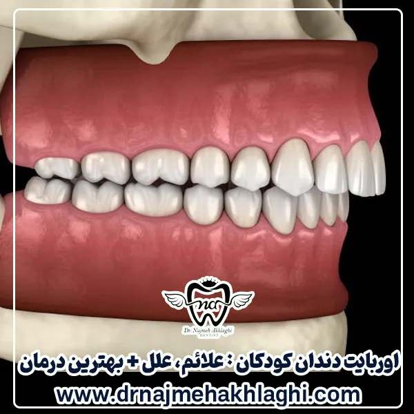 اوربایت دندان کودکان