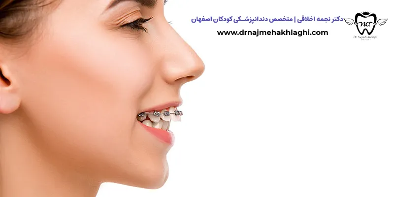 اوربایت دندان