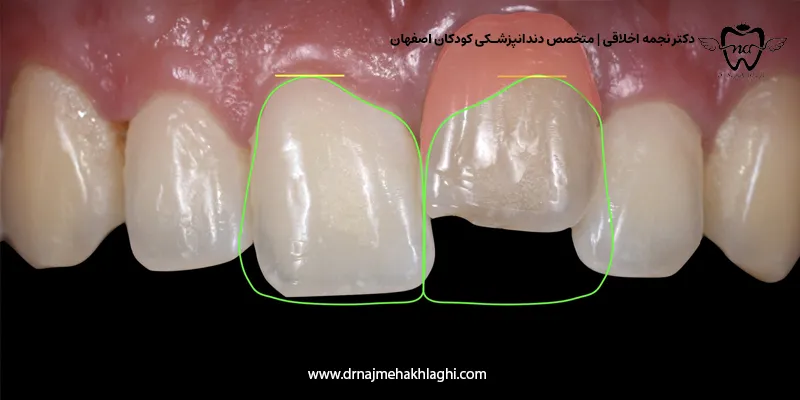دندان شیری فک جوش