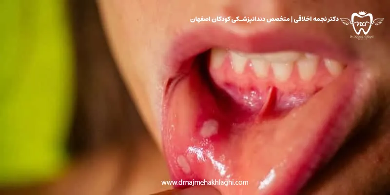 علت آفت دهان کودک