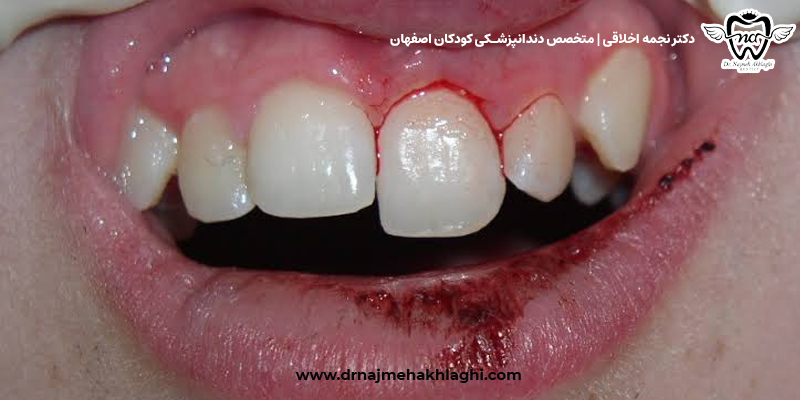  لق شدن دندان شیری کودک بر اثر ضربه 