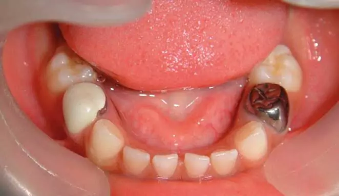 روکش دندان شیری کودک